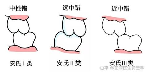 安氏Ⅱ類錯HE畸形的圖解與臨床解析